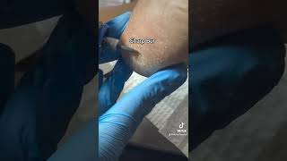 Painful Heel Porokeratosis Removal [upl. by Aerdua715]