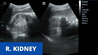 Acute Pyelonephritis  Ultrasound Case [upl. by Norvin]