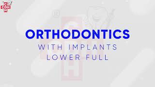 Do braces work with dental implants [upl. by Rubio]