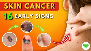 16 Early Signs of Skin Cancer You Should Never Ignore  Melanoma  Skin Cancer Symptoms [upl. by Rundgren]