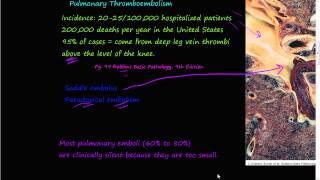 58PEtiology of Pulmonary embolism Saddle embolus Paradoxial embolism [upl. by Malva668]