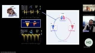 Right Ventricular Injury Patterns in Critical Care Cases [upl. by Leeda259]