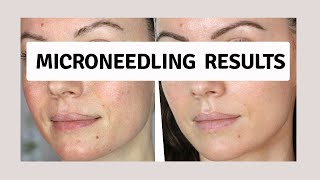 Microneedling Results  It Fixed My Skin 8 Sessions shorts [upl. by Eidualc964]