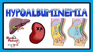 Hypoalbuminemia  Functions of Albumin in the Body  Pathophysiology of Hypoalbuminemia [upl. by Ernie]