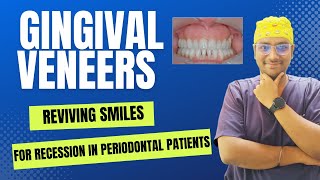 Dr Rudra Mohan  GINGIVAL VENEERS  Reviving Smiles in Periodontal Patients with Gingival Recession [upl. by Nylesoj]