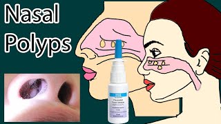 Nasal Polyps symptoms causes and treatment [upl. by Auhsej]