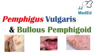 Vesiculobullous Skin Diseases  Pemphigus Vulgaris vs Bullous Pemphigoid [upl. by Finbar482]