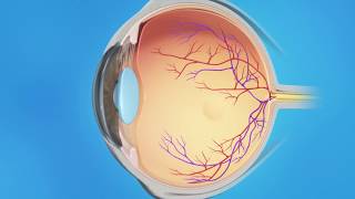 Vitreomacular Adhesion Medication Injections [upl. by Anelet]