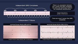 Third Degree Atrioventricular Block ECG [upl. by Enifesoj]