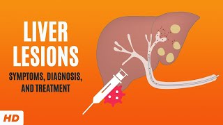 Liver Lesions Symptoms Diagnosis and Treatment [upl. by Ennyleuqcaj]