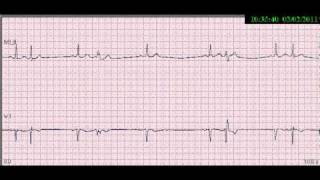 05EKGCOMPLEXO ATRIAL PREMATURO [upl. by Adaran]