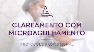 Protocolo de Tratamento da Melasma com Microagulhamento [upl. by Ahtanoj496]