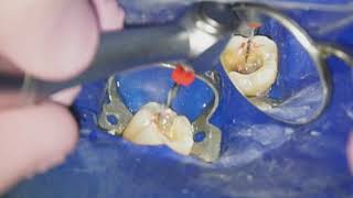 Endodontiste Hugo Setbon  Le retraitement endodontique [upl. by Levania]