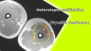 Heterotopic ossification Myositis Ossificans Medical Documentary [upl. by Oicnedurp]