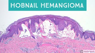 Hobnail Hemangioma Targetoid Hemosiderotic Hemangioma Retiform Hemangioendothelioma and Mimics [upl. by Mcevoy]