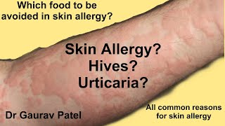 Skin allergy  Urticaria  Reasons and Which food to be avoided in allergy [upl. by Lombardo]