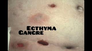 ecthyma causes symptoms and treatment dermatologyskin disease [upl. by Ricketts594]