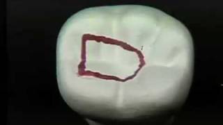 Endodontic Cavity Preparation  Phase I  Posterior [upl. by Veronique]