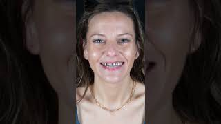 All on 4 Dental Implants in Los Algodones Mexico Lisas Dental Transformation [upl. by Nixon]