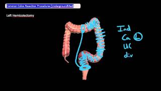 Common Colon Resection Procedures Undergroundmed [upl. by Clay]