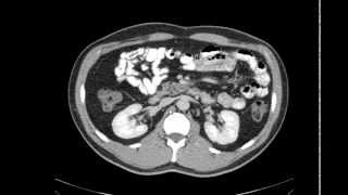 Overview da anatomia do abdome pela TC [upl. by Kama]