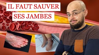 ARTÈRES des jambes BOUCHÉES et ULCÈRE de la PEAU ce quil faut savoir [upl. by Server563]