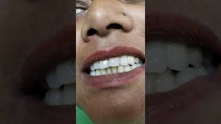 dental treatment fpddental procedures [upl. by Easter]