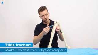 Wat is een scheenbeenbreuk tibia fractuur [upl. by Nash]