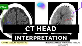 CT Head Interpretation for Beginners  OSCE Guide  UKMLA  CPSA [upl. by Cirdahc]