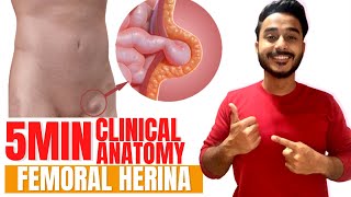 femoral hernia anatomy clinical anatomy of femoral triangle  femoral triangle clinical anatomy [upl. by Omolhs]