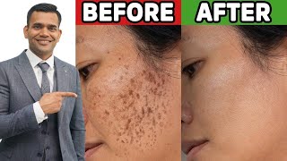 Do you have Dark Spots Pigmentation Just follow this for 100  gauranteed Result 👍  Tamil [upl. by Wilton]