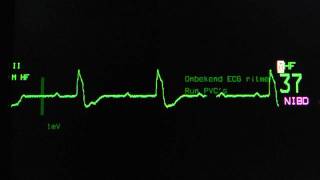 sinus rhythm third degree complete AV block ventricular escape rhythm on an ECG heart monitor [upl. by Aisha]