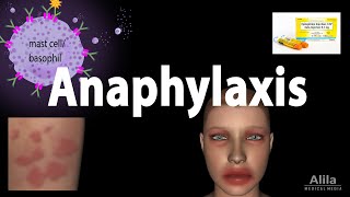 Anaphylaxis Animation [upl. by Arol]