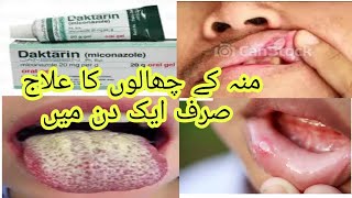 daktarin oral gel how to use miconazole gel oral thrush treatment [upl. by Siana]