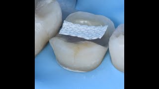 HOW A CERAMIC ONLAY CAN SAVE A TOOTH [upl. by Etnelav]