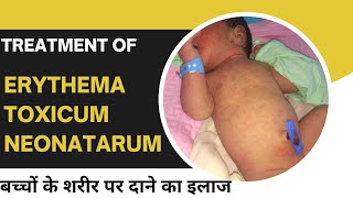 Erythema toxicum neonatarum skin rashes in newborn baby cause and treatmentDr Uttam kumar Lenka [upl. by Ellennod629]