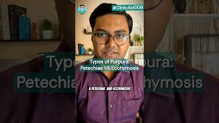 Types of Purpura Petechiae VS Ecchymosis for USMLE NEET PG NCLEX INICET [upl. by Phelps424]