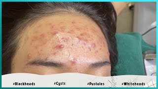 Big Cystic Acne Blackheads Extraction Blackheads amp Milia Whiteheads Removal Pimple Popping [upl. by Eurd]