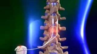 Spinal cord stimulator [upl. by Stephenson]