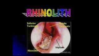 RHINOLITH [upl. by Ganiats599]