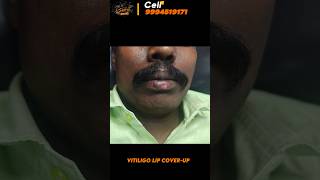 Vitiligo lips cover up  vitiligo treatment vitiligo lips vitiligo skin treatment trichy [upl. by Revned]