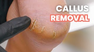 HUGE Heel Cracks  Callus Removal [upl. by Leona864]