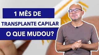 O TRANSPLANTE CAPILAR DEU ERRADO 1 MÊS DESDE A CIRURGIA [upl. by Laroy236]