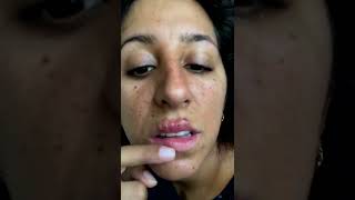 Cystic acne and blackheads removal  Newest pimple pops for 2022 [upl. by Siryt]