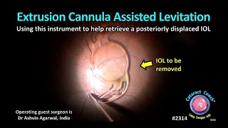 CataractCoach™ 2314 extrusion cannula IOL levitation [upl. by Kat887]