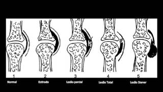 Lesão de Stener lesão do ligamento colateral ulnar do polegar [upl. by Brote813]