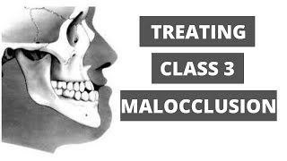 Management of Class 3 Malocclusion Orthodontics [upl. by Sass]