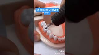 How to Fill a Cavity [upl. by Ricoriki]