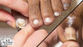 How to Fix Ingrown Toenails at Home nails satisfying [upl. by Raimes421]