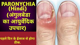 Paronychia finger nail infection in Hindi  पेरोनिसिया नाखूनों का संक्रमण  अंगुलबेडा घरेलू उपचार [upl. by Ecirtnuahs825]